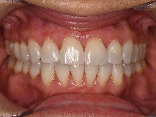 3-cindy-after-invisalign