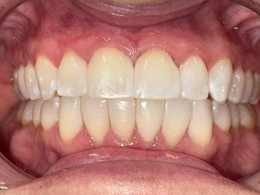 madison-park-family-dentistry-cindy-after-bioclear-